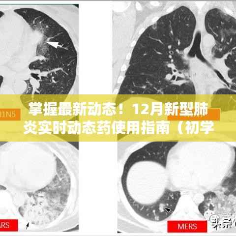 掌握最新動態(tài)！全面解讀，新型肺炎藥物使用指南（初學(xué)者進(jìn)階版）